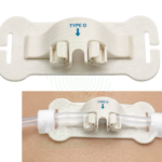 Body surface conduit fixing device - Type D Amaris Medical